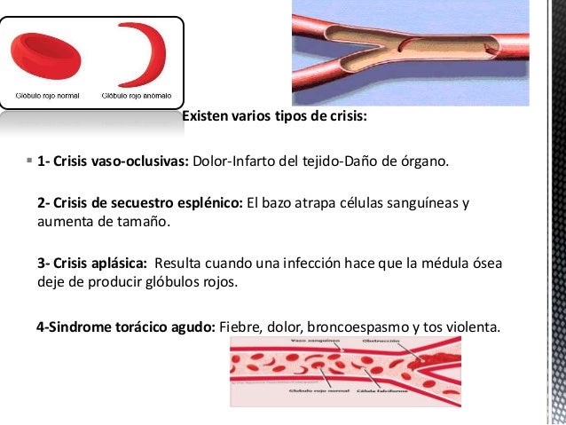 anemia drepanocitica pediatria